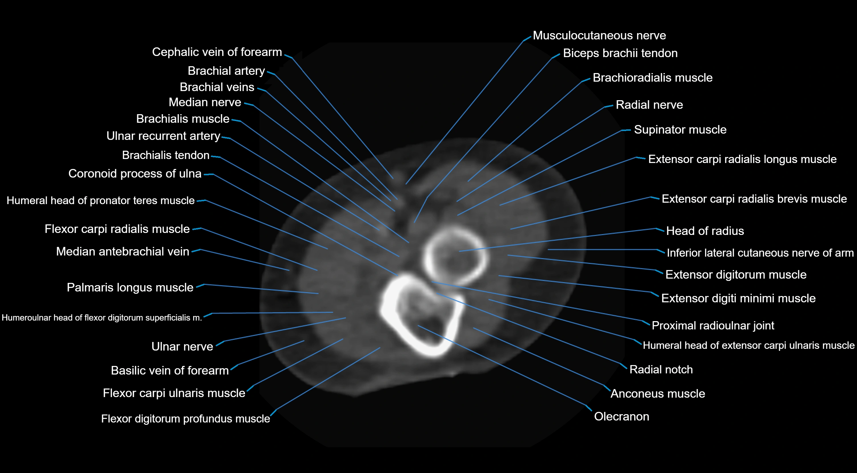 CT elbow axial  cross sectional anatomy labelled  radiology image -00033.webp